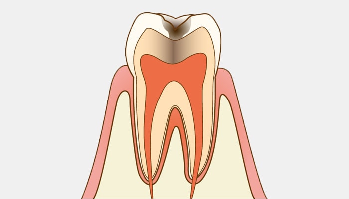 C2：象牙質の虫歯