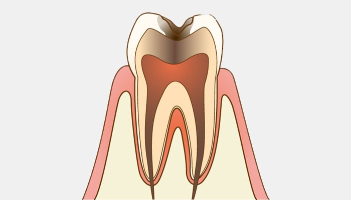 C3：神経に達した虫歯