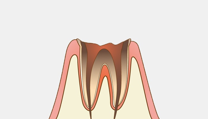 C4：歯根に達した虫歯