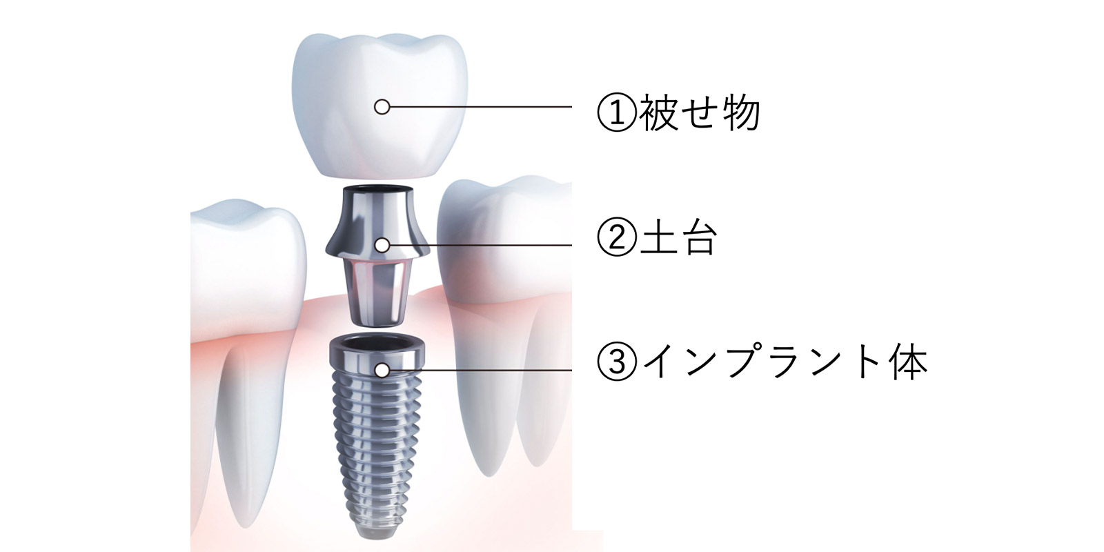 インプラントの構成