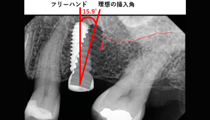 フリーハンドではリスク有