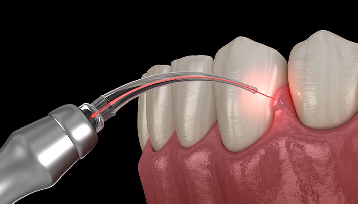 歯科用レーザーを用いた歯周病治療にも対応